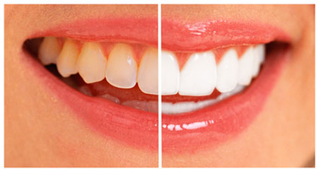 Teeth Whitening 4 You - How to Whiten Your Teeth Easily, Naturally 